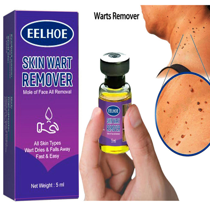 Achill remover